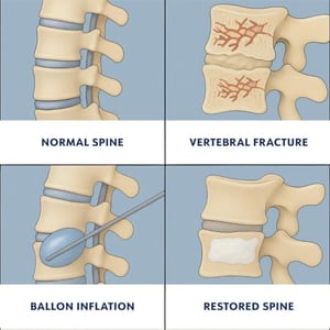 Kyphoplasty