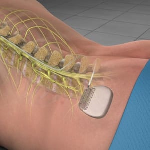Spinal Cord Stimulator — Trial & Implant