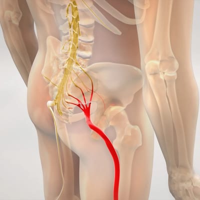 Back Pain with Radiculopathy