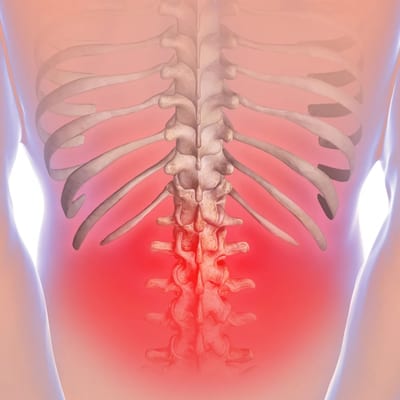 Lumbar Facet Pain Syndrome