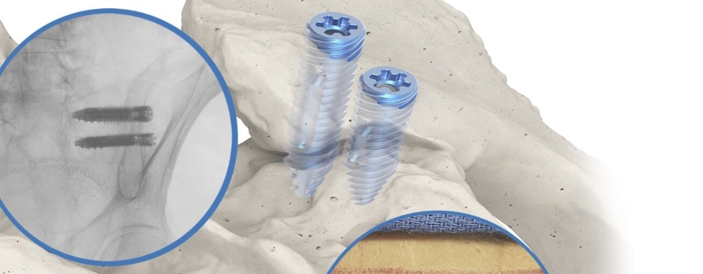 Sacroiliac joint fusion implant screws illustrated in bone anatomy
